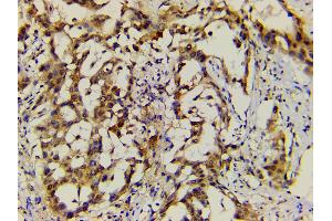 ABIN6277691 at 1/200 staining human lung cancer tissue sections by IHC-P. (Ephrin B2 抗体  (C-Term))