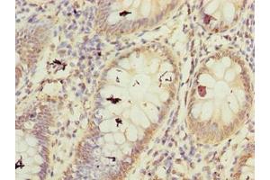 Immunohistochemistry of paraffin-embedded human colon cancer using ABIN7152486 at dilution of 1:100 (BTRC 抗体  (AA 701-1000))