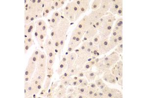 Immunohistochemistry of paraffin-embedded human liver cancer using UHRF2 antibody at dilution of 1:200 (400x lens). (UHRF2 抗体)