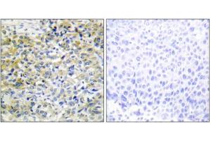 Immunohistochemistry analysis of paraffin-embedded human liver carcinoma tissue using CARKL antibody. (SHPK 抗体  (N-Term))