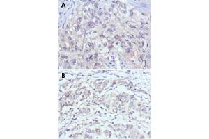 Immunohistochemical analysis of paraffin-embedded human lung cancer (A) and gastric cancer (B) using PAK2 monoclonal antibody, clone 3B5  with DAB staining.