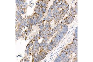 Immunohistochemistry of paraffin-embedded human colon carcinoma using  Rabbit mAb (ABIN7265424) at dilution of 1:1000 (40x lens). (ACSL4 抗体)
