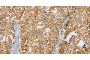 Immunohistochemistry of paraffin-embedded Human breast cancer tissue using SLC9A3R2 Polyclonal Antibody at dilution 1:30