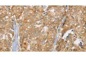 Immunohistochemistry of paraffin-embedded Human breast cancer tissue using SLC9A3R2 Polyclonal Antibody at dilution 1:30 (SLC9A3R2 抗体)