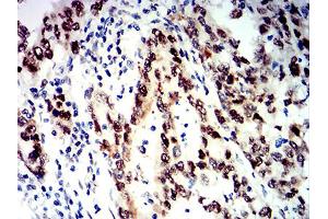 Immunohistochemical analysis of paraffin-embedded stomach cancer tissues using SMARCA1 mouse mAb with DAB staining. (SMARCA1 抗体  (AA 933-1070))