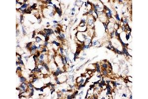 IHC-P: MEK1 antibody testing of human breast cancer tissue (MEK1 抗体  (C-Term))