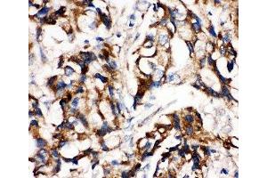 IHC-P: MEK1 antibody testing of human breast cancer tissue (MEK1 抗体  (C-Term))