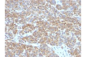 Formalin-fixed, paraffin-embedded human Melanoma stained with Bcl-2 Mouse Monoclonal Antibody (BCL2/782). (Bcl-2 抗体)