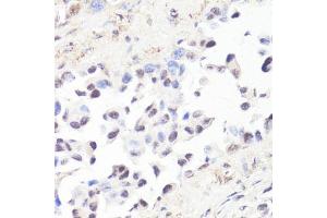 Immunohistochemistry of paraffin-embedded human lung cancer using P-MYC-T58 antibody (ABIN3019538, ABIN3019539, ABIN3019540 and ABIN6225454) at dilution of 1:100 (40x lens). (c-MYC 抗体  (pThr58))