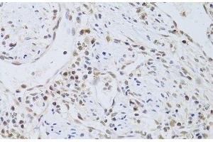 Immunohistochemistry of paraffin-embedded Human gastric cancer using FKBP4 Polyclonal Antibody at dilution of 1:100 (40x lens). (FKBP4 抗体)