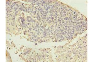 Immunohistochemistry of paraffin-embedded human cervical cancer using ABIN7144611 at dilution of 1:100 (ARMC7 抗体  (AA 1-198))