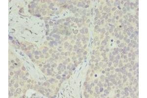 Immunohistochemistry of paraffin-embedded human gastric cancer using ABIN7142542 at dilution of 1:100 (RPS28 抗体  (AA 1-69))
