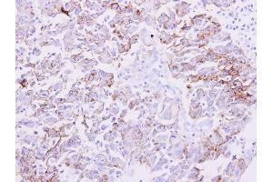 IHC-P Image NDRG1 antibody detects NDRG1 protein at membrane on human liver carcinoma by immunohistochemical analysis. (NDRG1 抗体)