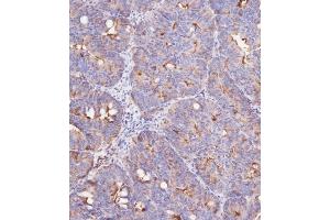 Immunohistochemical analysis of (ABIN387989 and ABIN2845007) on paraffin-embedded Human colon carcinoma tissue was performed on the Leica®BOND RXm.