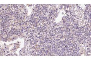ABIN6273155 at 1/100 staining Human lymph cancer tissue by IHC-P. (RND3 抗体  (Internal Region))