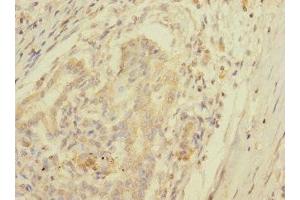 Immunohistochemistry of paraffin-embedded human pancreatic cancer using ABIN7157671 at dilution of 1:100 (SPC25 抗体  (AA 1-224))