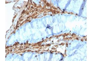 Formalin-fixed, paraffin-embedded human Colon Carcinoma stained with Annexin A1 Mouse Monoclonal Antibody (CPTC-ANXA1-1). (Annexin a1 抗体)