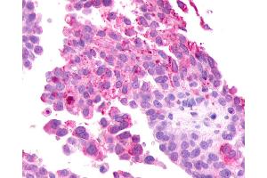 Anti-GRM2 / MGLUR2 antibody IHC of human Ovary, Carcinoma. (GRM2 抗体  (N-Term))