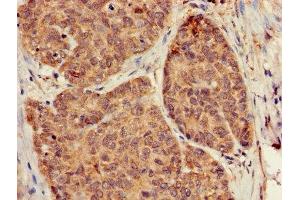 Immunohistochemistry of paraffin-embedded human ovarian cancer using ABIN7154745 at dilution of 1:100 (GNB5 抗体  (AA 1-353))