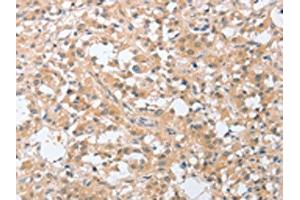 The image on the left is immunohistochemistry of paraffin-embedded Human thyroid cancer tissue using ABIN7131059(SIGLEC9 Antibody) at dilution 1/30, on the right is treated with fusion protein. (SIGLEC9 抗体)
