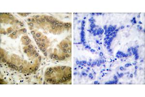 Peptide - +Immunohistochemical analysis of paraffin-embedded human lung carcinoma tissue using HDAC7 antibody (#C0227). (HDAC7 抗体)