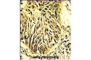 Formalin-fixed and paraffin-embedded human lung carcinoma with C Antibody (Center), which was peroxidase-conjugated to the secondary antibody, followed by DAB staining. (PROCR 抗体  (AA 104-132))