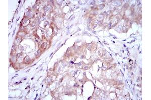 Immunohistochemical analysis of paraffin-embedded lung cancer using MTHFR mouse mAb with DAB staining. (MTHFR 抗体)