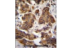 C4orf21 Antibody (N-term) (ABIN655214 and ABIN2850480) immunohistochemistry analysis in formalin fixed and paraffin embedded human bladder carcinoma followed by peroxidase conjugation of the secondary antibody and DAB staining. (ZGRF1 抗体  (N-Term))