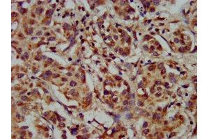 IHC image of ABIN7142850 diluted at 1:300 and staining in paraffin-embedded human liver cancer performed on a Leica BondTM system. (CYP8B1 抗体  (AA 303-440))