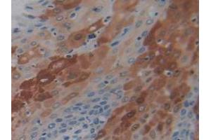 IHC-P analysis of Human Stomach Cancer Tissue, with DAB staining. (PD-1 抗体  (AA 41-132))