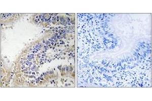 Immunohistochemistry analysis of paraffin-embedded human breast carcinoma tissue, using DHODH Antibody. (DHODH 抗体  (AA 211-260))