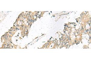 Immunohistochemistry of paraffin-embedded Human colorectal cancer tissue using MGAT4B Polyclonal Antibody at dilution of 1:50(x200)