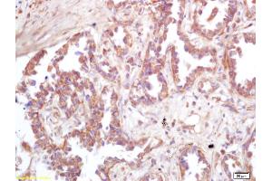 Formalin-fixed and paraffin embedded human lung carcinoma labeled with Rabbit Anti ATP6IP2 Polyclonal Antibody, Unconjugated (ABIN872738) at 1:200 followed by conjugation to the secondary antibody and DAB staining (ATP6AP2 抗体  (AA 280-350))
