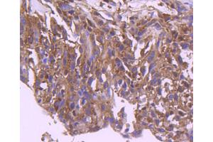 Paraformaldehyde-fixed, paraffin embedded human breast carcinoma, Antigen retrieval by boiling in sodium citrate buffer (pH6) for 15min, Block endogenous peroxidase by 3% hydrogen peroxide for 30 minutes, Blocking buffer (normal serum) at 37°C for 20min, Antibody incubation with IRF3 (4C3) Monoclonal Antibody  at 1:50 overnight at 4°C, followed by a conjugated secondary and DAB staining. (IRF3 抗体)