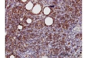 Immunoperoxidase of monoclonal antibody to SPRY2 on formalin-fixed paraffin-embedded human lymphoma. (SPRY2 抗体  (AA 1-315))