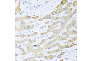 Immunohistochemistry of paraffin-embedded human liver cancer using FDXR antibody. (Ferredoxin Reductase 抗体  (AA 252-491))