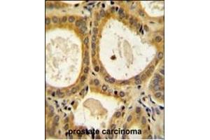 CTLA4 Antibody (N-term) (ABIN654422 and ABIN2844157) immunohistochemistry analysis in formalin fixed and paraffin embedded human prostate carcinoma followed by peroxidase conjugation of the secondary antibody and DAB staining. (CTLA4 抗体  (AA 50-78))