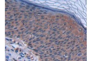 IHC-P analysis of Human Skin cancer Tissue, with DAB staining.