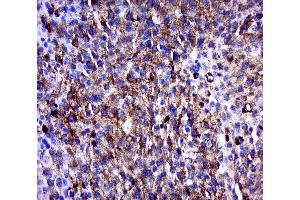 Paraformaldehyde-fixed, paraffin embedded human melanoma , Antigen retrieval by boiling in sodium citrate buffer (pH6. (MAGEB6 抗体  (AA 151-250))