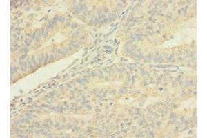 Immunohistochemistry of paraffin-embedded human endometrial cancer using ABIN7173241 at dilution of 1:100 (TMEM56 抗体  (AA 232-263))