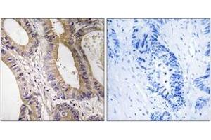 Immunohistochemistry analysis of paraffin-embedded human colon carcinoma tissue, using STK24 Antibody. (STK24 抗体  (AA 319-368))