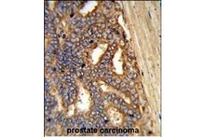 Formalin-fixed and paraffin-embedded human prostate carcinoma reacted with Y1A Antibody (Center), which was peroxidase-conjugated to the secondary antibody, followed by DAB staining. (AMY1A 抗体  (AA 195-223))