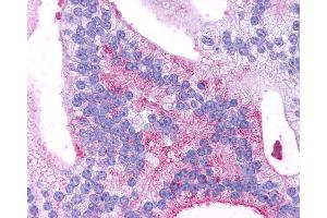 Anti-GPR88 antibody IHC of human Prostate, Carcinoma.
