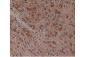 IHC-P analysis of Human Glioma Tissue, with DAB staining. (APOA1BP 抗体  (AA 118-282))