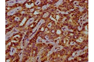 IHC image of ABIN7175529 diluted at 1:200 and staining in paraffin-embedded human liver cancer performed on a Leica BondTM system. (VKORC1 抗体  (AA 30-74))