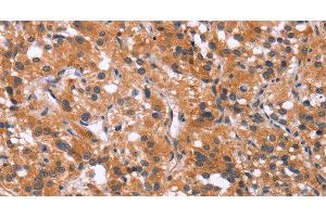 Immunohistochemistry of paraffin-embedded Human thyroid cancer using MAPK11 Polyclonal Antibody at dilution of 1:30 (MAPK11 抗体)