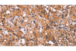 Immunohistochemistry of paraffin-embedded Human thyroid cancer using MAPK11 Polyclonal Antibody at dilution of 1:30