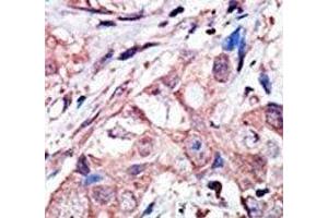 IHC analysis of FFPE human breast carcinoma tissue stained with the JNK3 antibody (MAPK10 抗体  (AA 1-30))