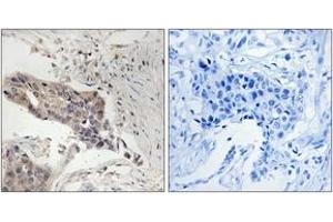 Immunohistochemistry analysis of paraffin-embedded human breast carcinoma tissue, using SLP-76 (Ab-128) Antibody. (LCP2 抗体  (AA 94-143))