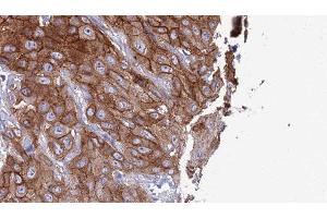 ABIN6277320 at 1/100 staining Human Head and neck cancer tissue by IHC-P. (CLEC4A 抗体  (C-Term))